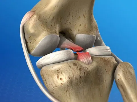Đứt dây chằng không còn là “án tử” với khớp gối: Công nghệ phục hồi không xâm lấn lên ngôi