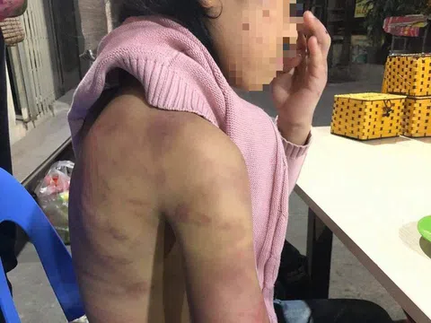 Bé gái 12 tuổi nghi bị mẹ đẻ bạo hành, người tình của mẹ cưỡng bức nhiều lần